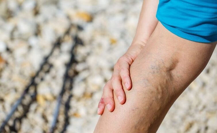 Varicose veins in the leg